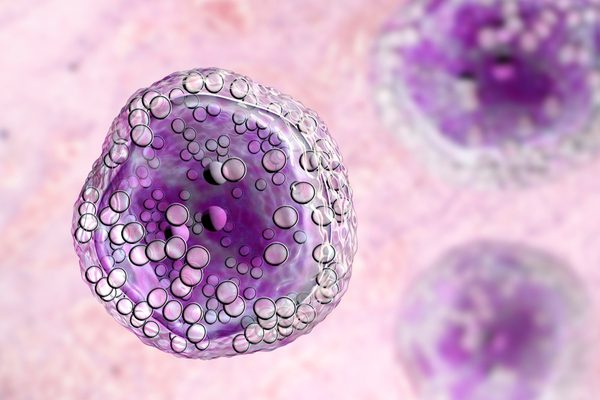 Burkitt's lymphoma cells Steven Kussick